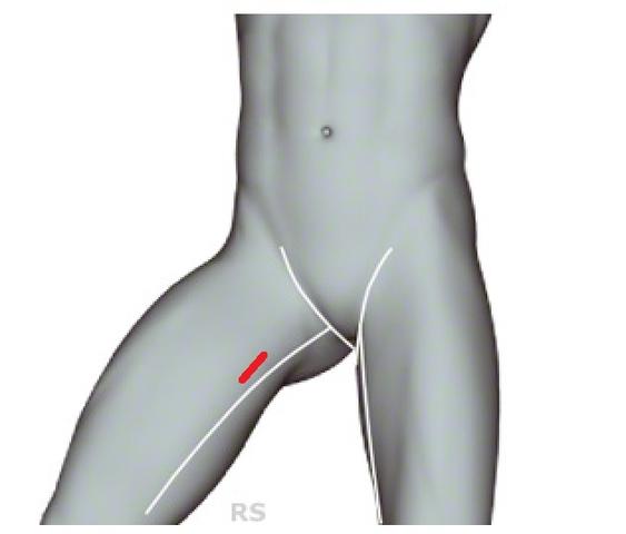 thrombose schmerzen im oberschenkel